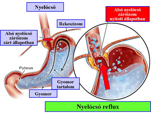 Nyelőcső fekély tünetei